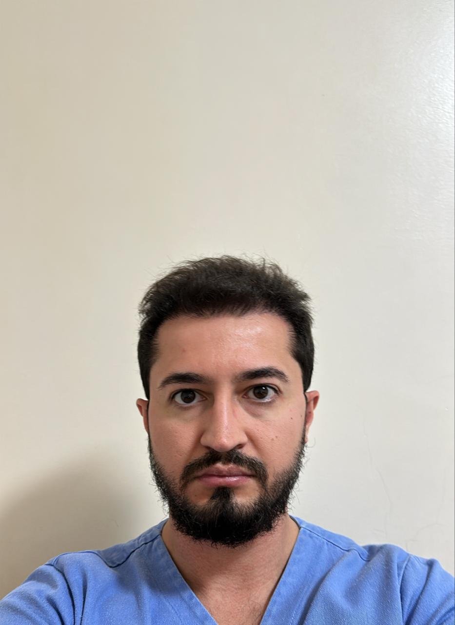 Mesmo paciente Duo Capilare depois do transplante capilar, com densidade recuperada