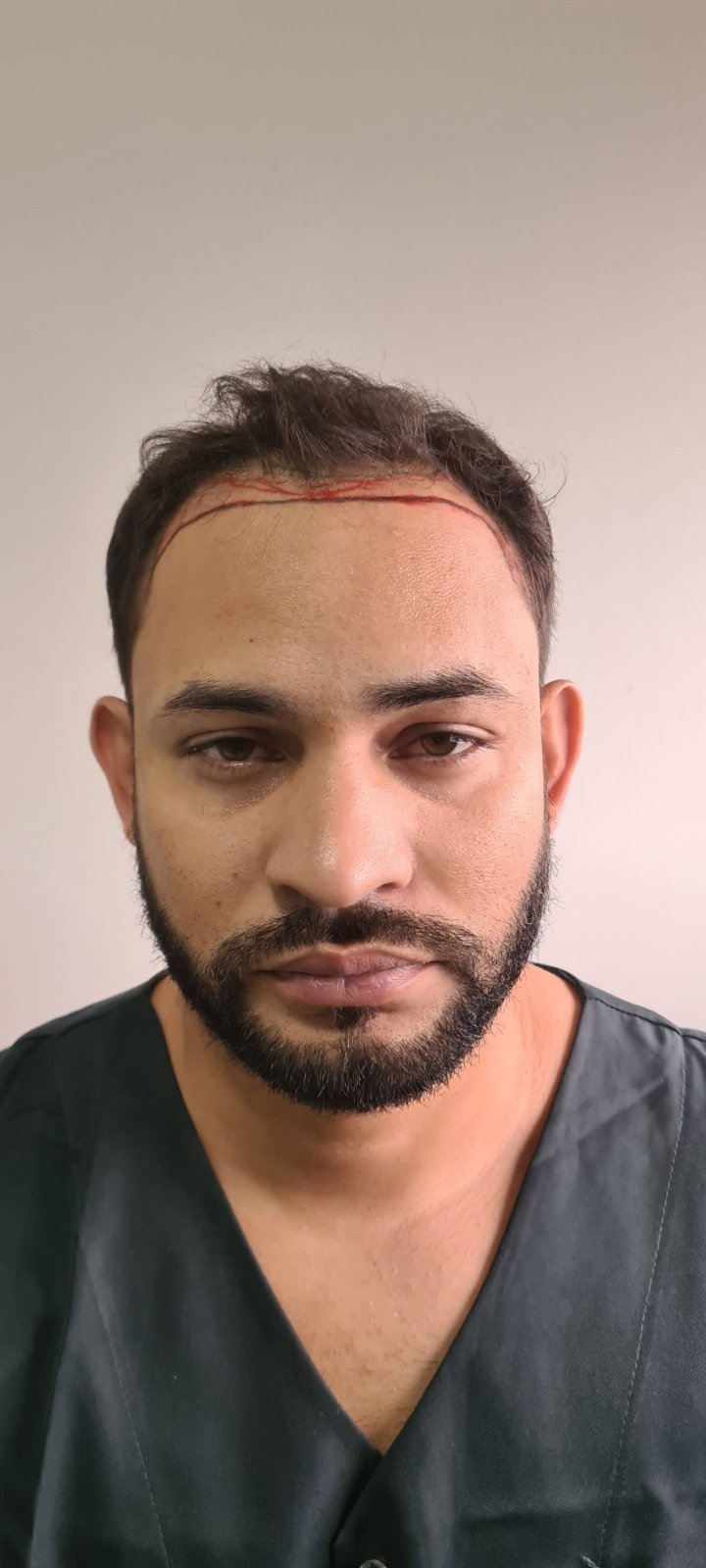 Paciente Duo Capilare antes do transplante capilar FUE, linha capilar marcada para planejamento