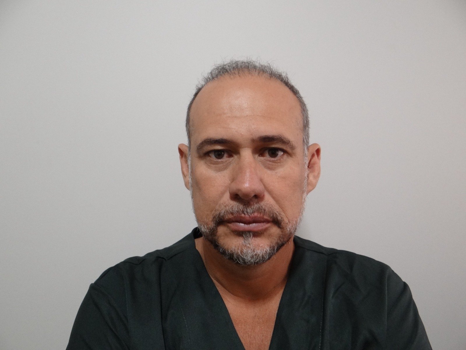 Paciente Duo Capilare antes do transplante capilar, entradas e coroa com fios finos
