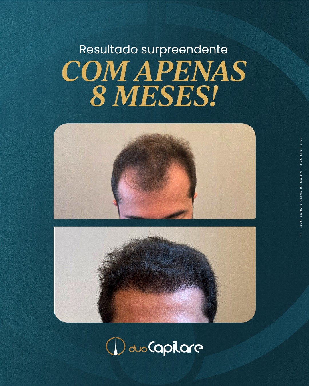 Resultado de transplante capilar FUE em 8 meses, paciente Duo Capilare, RT Dra. Andrea Viana de Matos CRM MG 66.172