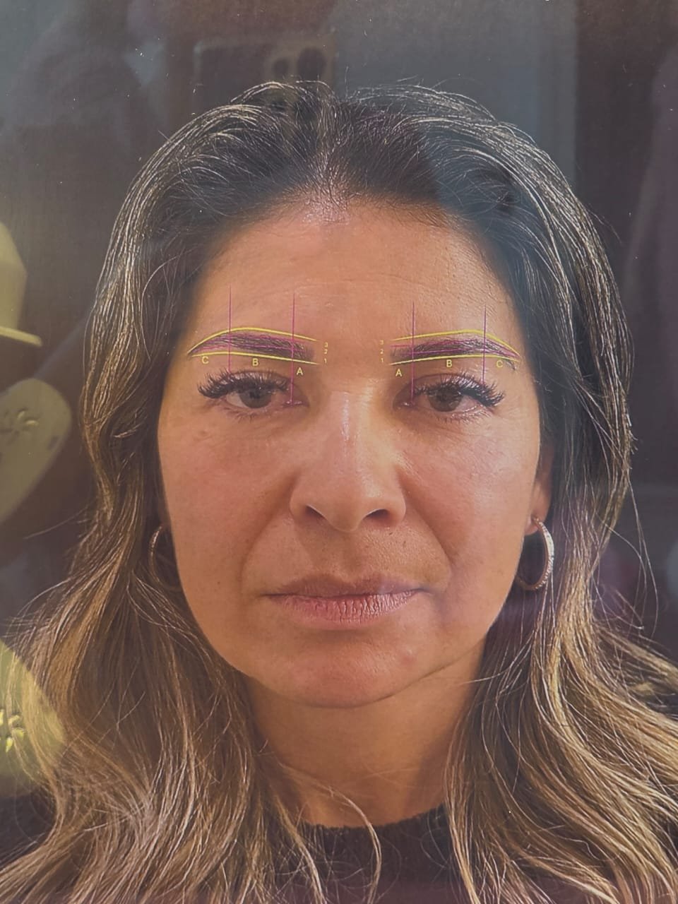 Procedimento de transplante de sobrancelha na Duo Capilare