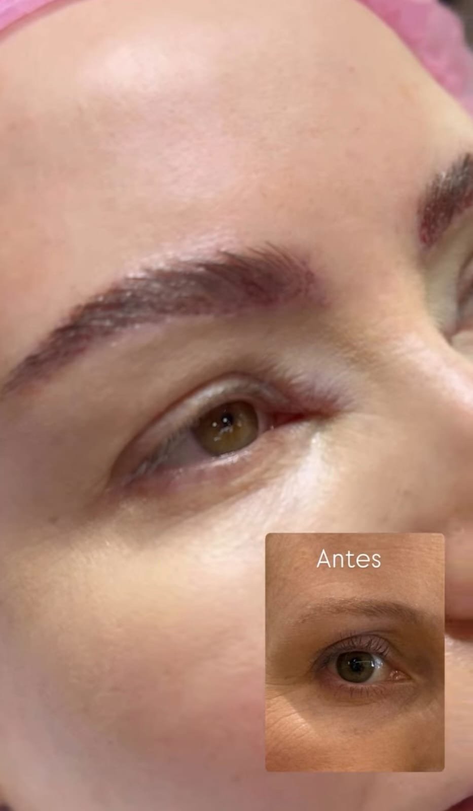 Antes e depois de transplante de sobrancelha na Duo Capilare em Montes Claros-MG