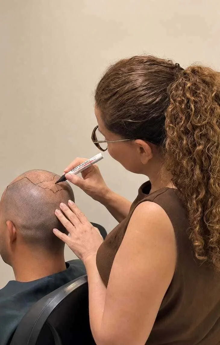 Dra. Andrea Viana de Matos marcando a linha capilar antes do transplante capilar FUE