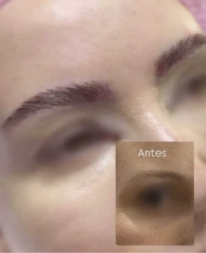 Antes e depois de transplante de sobrancelha na duoCapilare em Montes Claros-MG