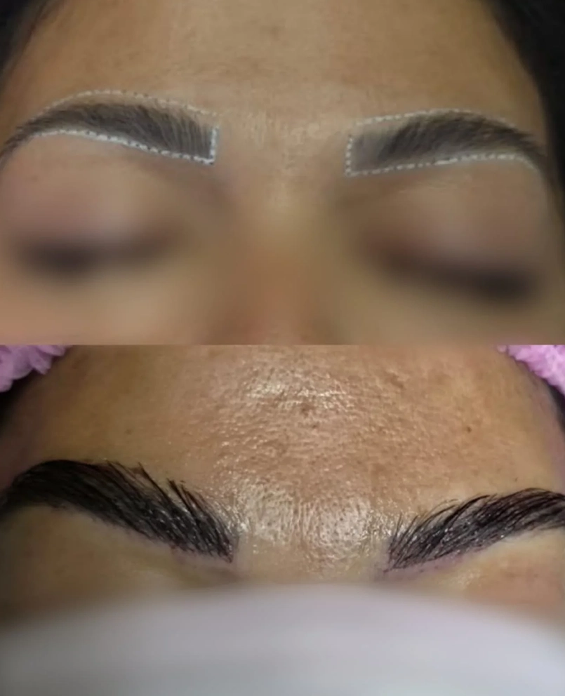 Antes e depois de transplante de sobrancelha, paciente 3 duoCapilare em Montes Claros-MG