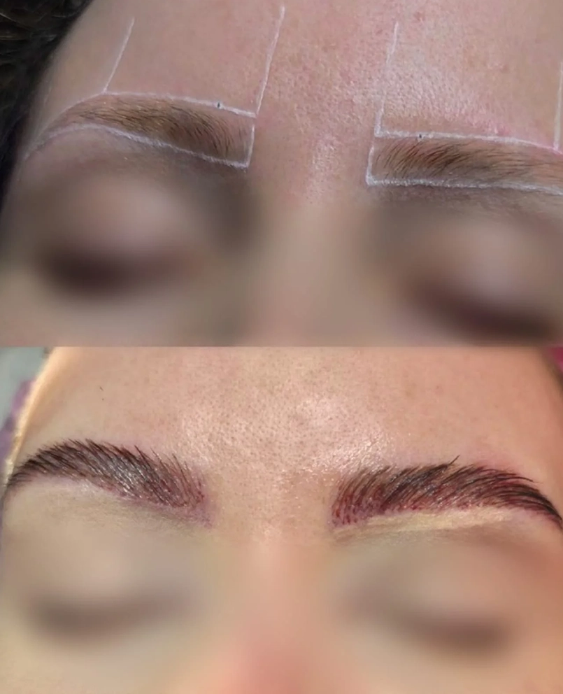 Antes e depois de transplante de sobrancelha, paciente 2 duoCapilare em Montes Claros-MG