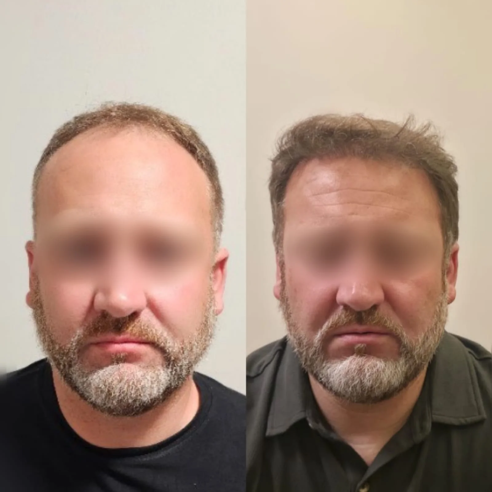 Antes e depois do transplante capilar FUE, paciente 1 duoCapilare em Montes Claros-MG
