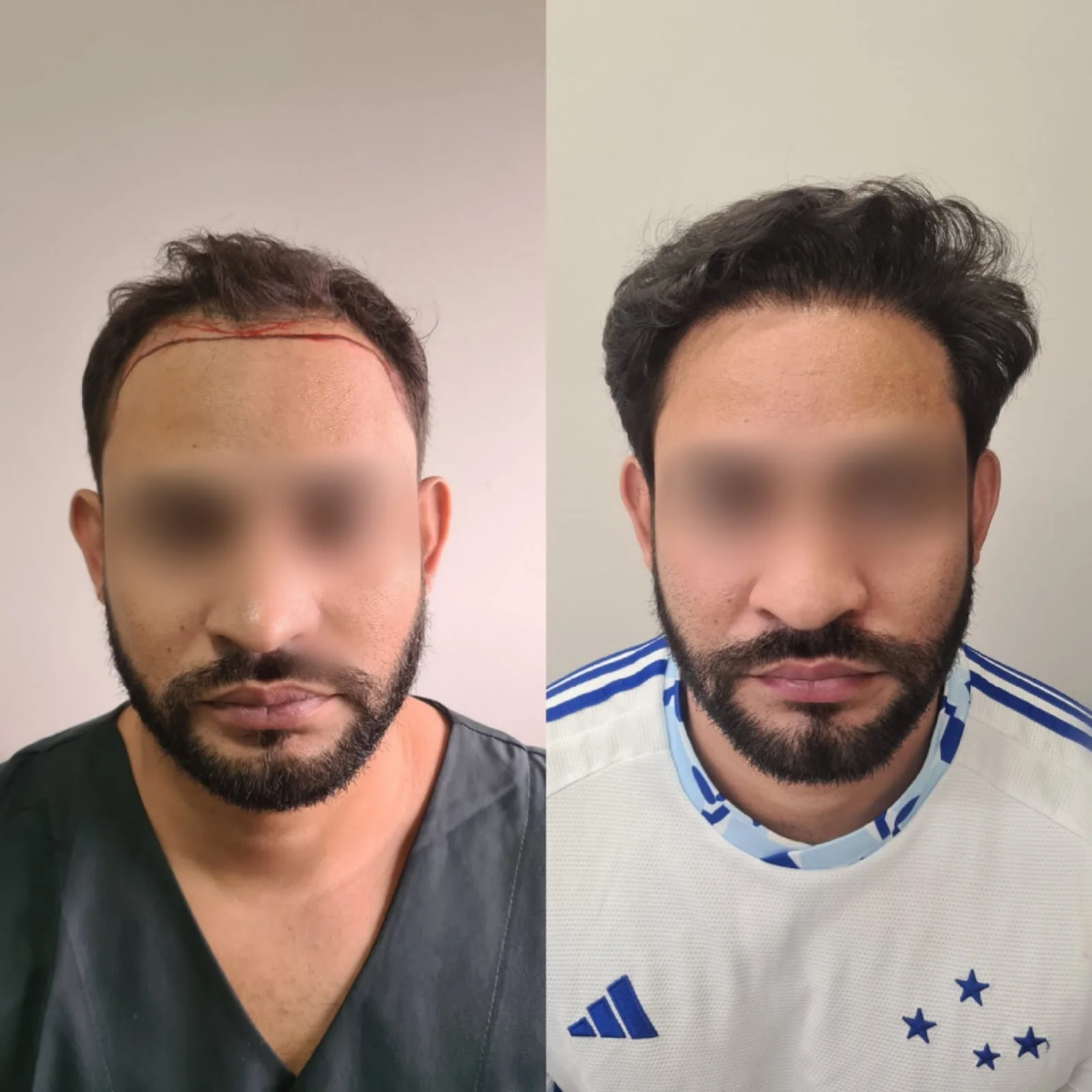 Antes e depois do transplante capilar FUE, paciente 2 duoCapilare em Montes Claros-MG