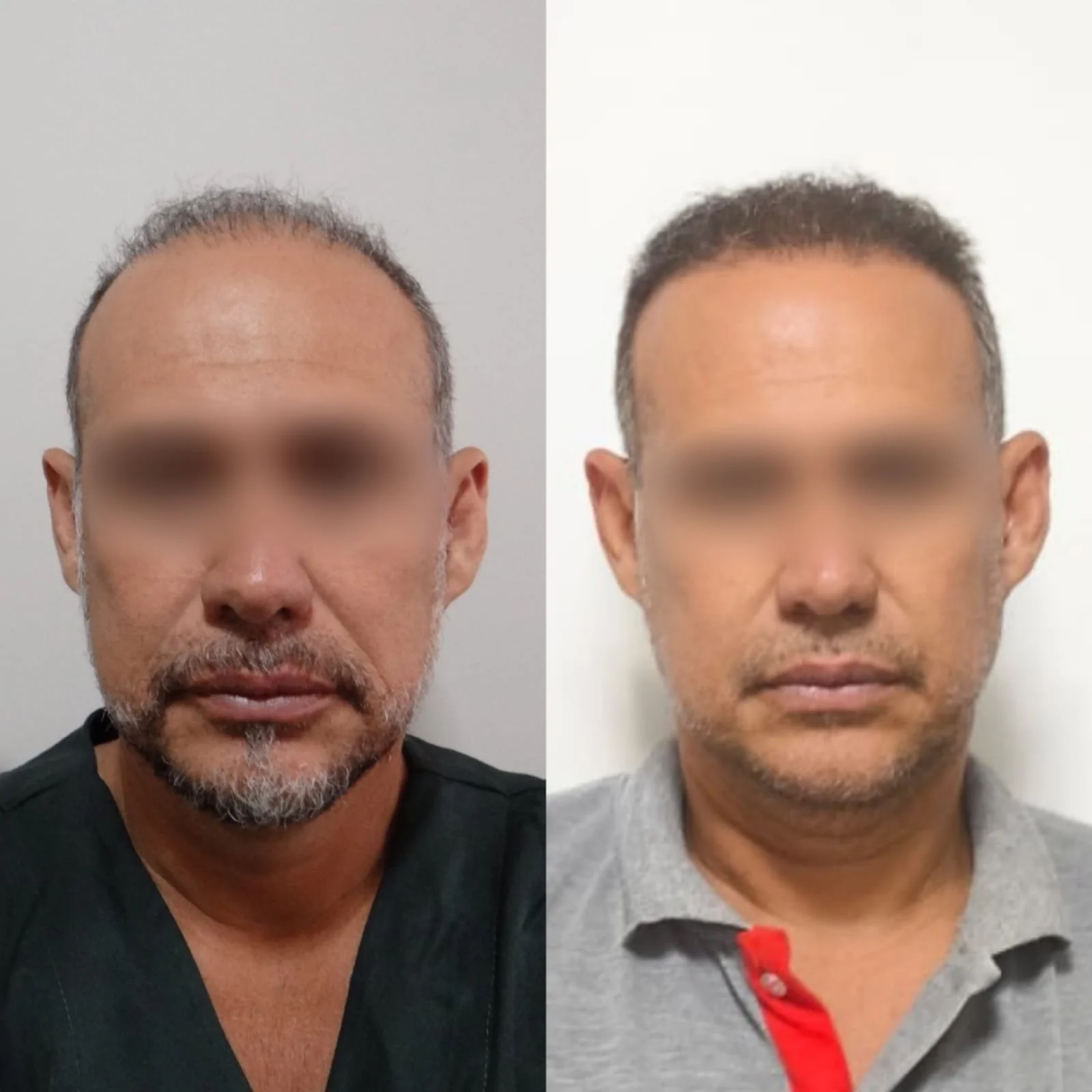 Antes e depois do transplante capilar FUE, paciente 3 duoCapilare em Montes Claros-MG