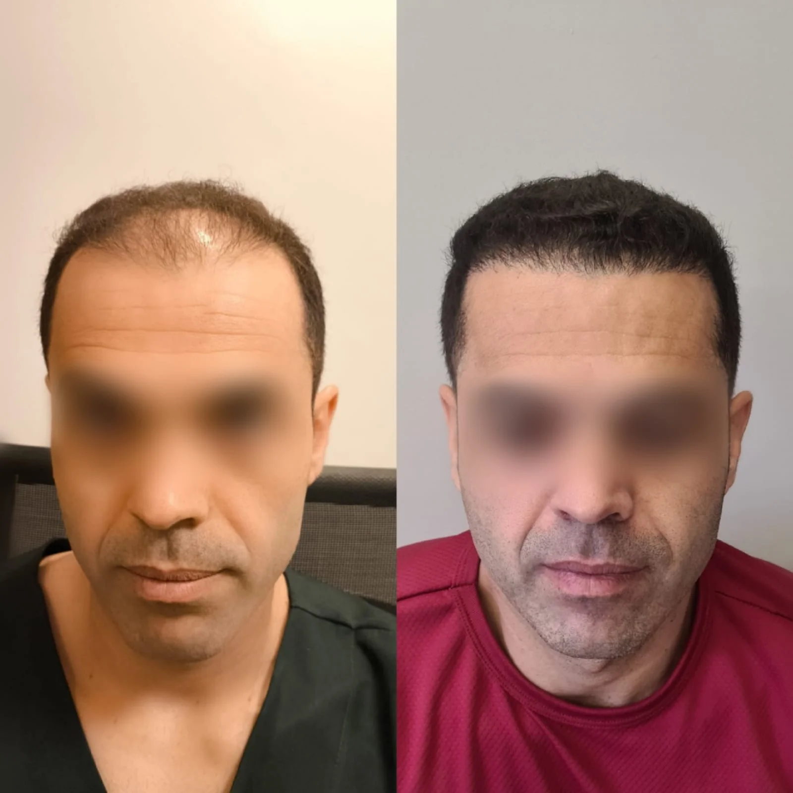 Antes e depois do transplante capilar FUE, paciente 4 duoCapilare em Montes Claros-MG