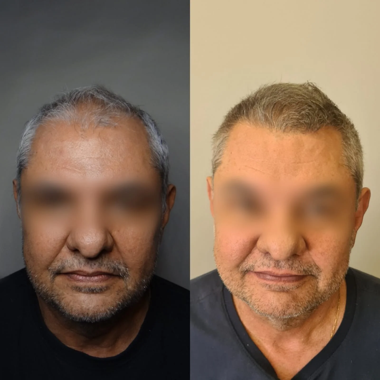 Antes e depois do transplante capilar FUE, paciente 5 duoCapilare em Montes Claros-MG