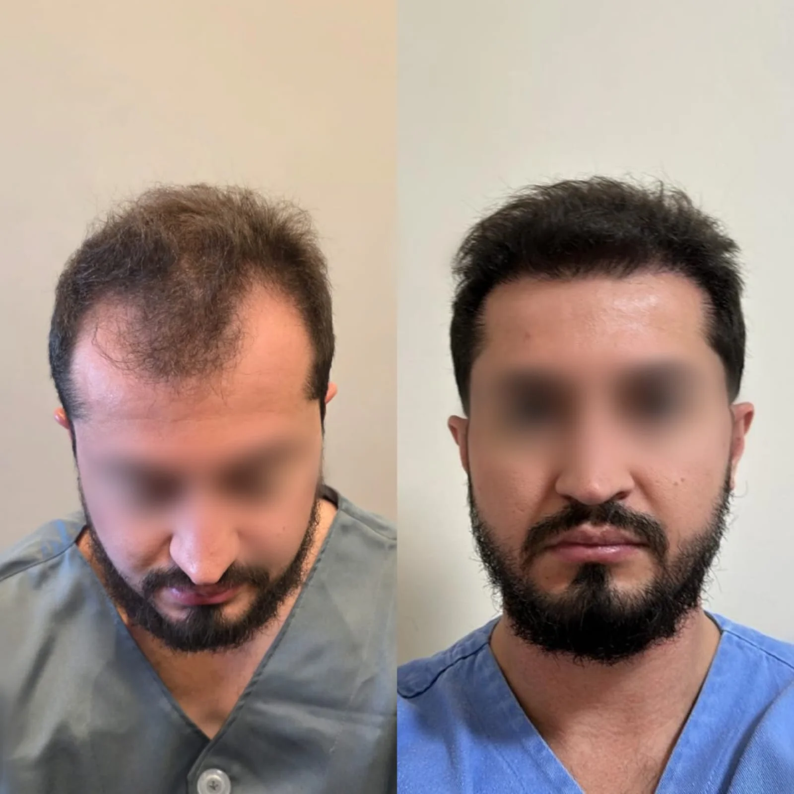 Antes e depois do transplante capilar FUE, paciente 6 duoCapilare em Montes Claros-MG